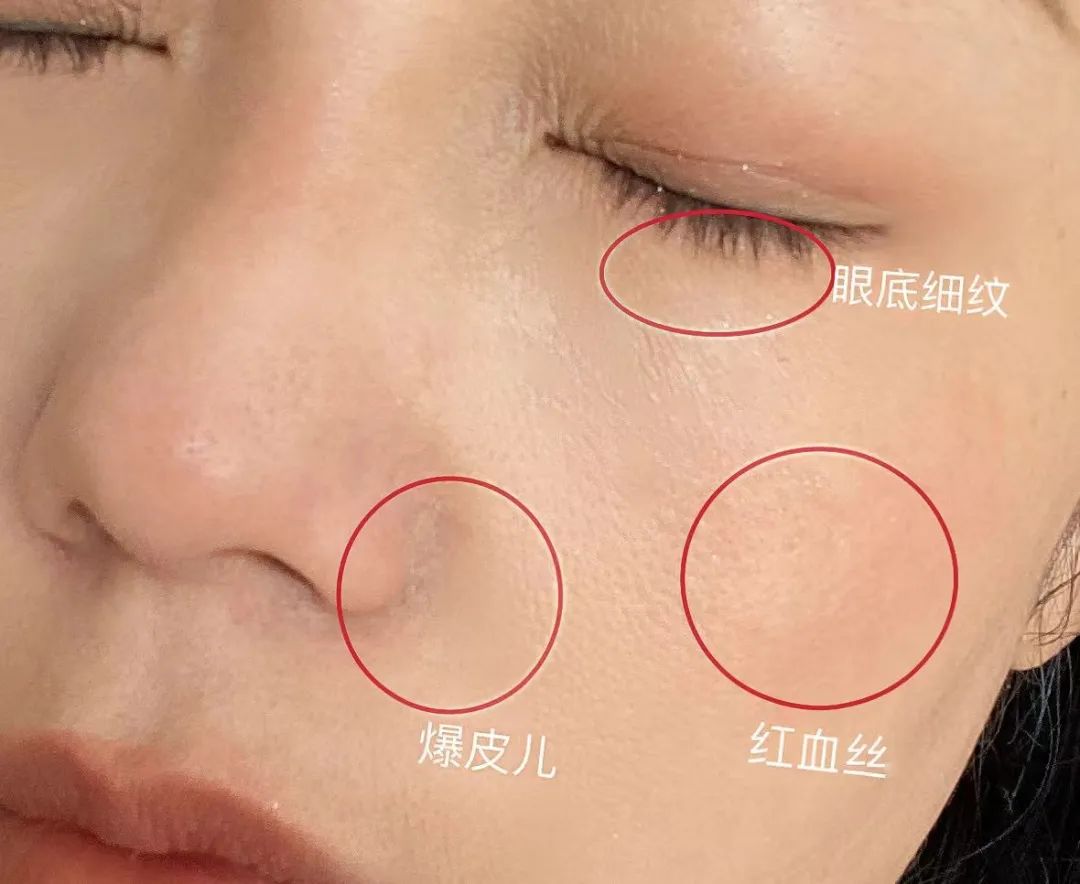 如何判断自己是不是干敏肌肤？干敏肌有哪些特征？